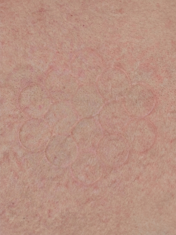 Faint circular marks on skin