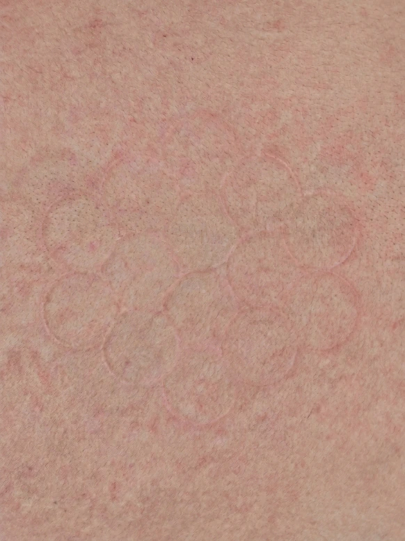 Faint circular marks on skin